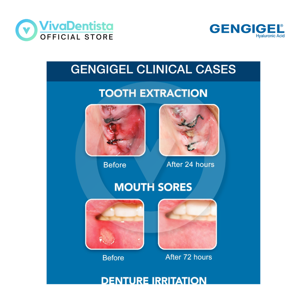 Gengigel 1ml (1sachet)
