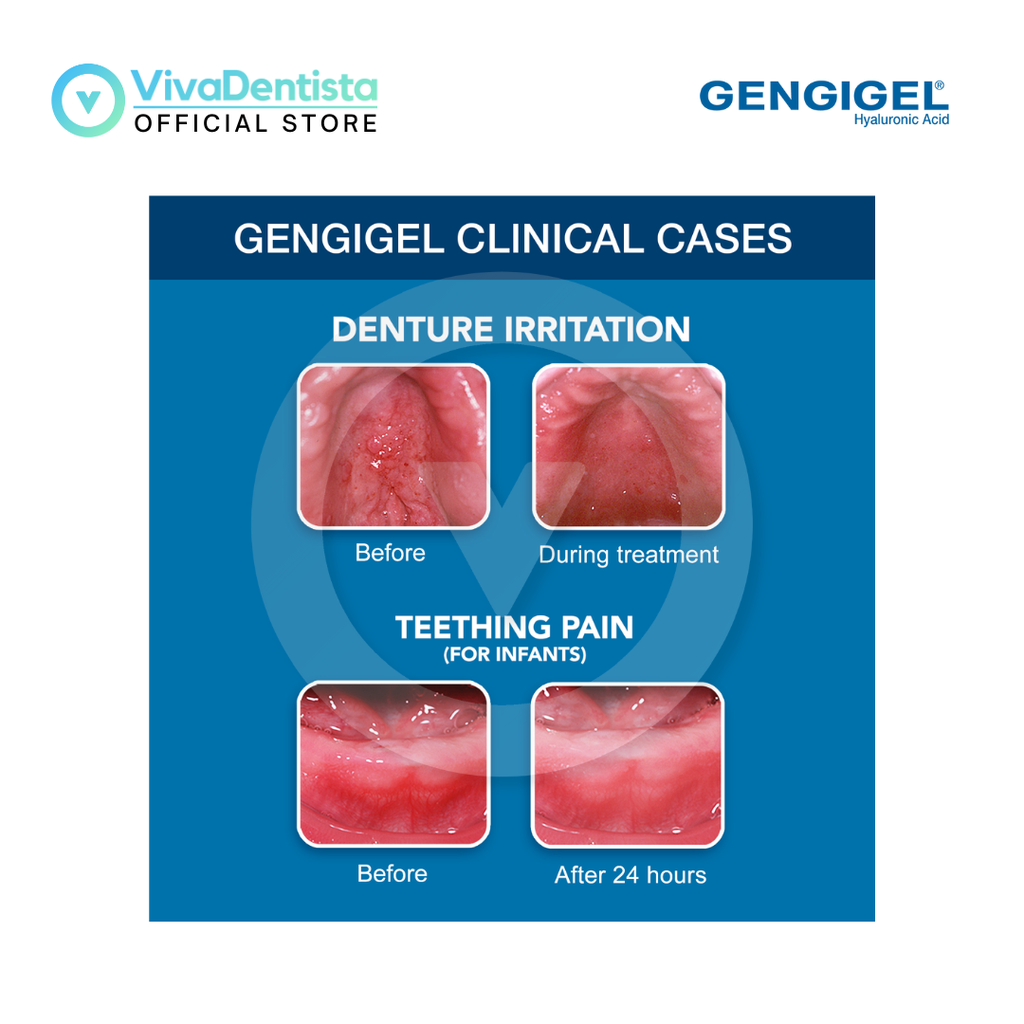 Gengigel 1ml (1sachet)